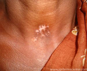 Vitiligo-Treated